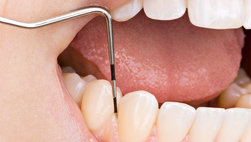 Zahnmedizin Heilbronn | Detailansicht einer Parodontose-Behandlung